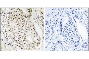 Immunohistochemistry analysis of paraffin-embedded human breast carcinoma tissue, using HNRNPUL2 Antibody. (HNRNPUL2 抗体  (AA 601-650))