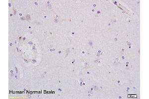 Formalin-fixed and paraffin embedded human glioma tissue labeled with Anti-PCNA Polyclonal Antibody, Unconjugated (ABIN676583) at 1:200 followed by conjugation to the secondary antibody and DAB staining (PCNA 抗体  (AA 151-261))