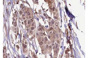 ABIN6272333 at 1/100 staining Human breast cancer tissue by IHC-P. (KIF13B 抗体  (C-Term))