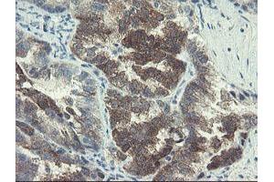 Immunohistochemical staining of paraffin-embedded Adenocarcinoma of Human ovary tissue using anti-DOK7 mouse monoclonal antibody. (DOK7 抗体)