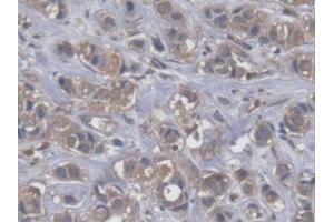 DAB staining on IHC-P; Samples: Human Breast cancer Tissue (EEF2 抗体  (AA 32-233))
