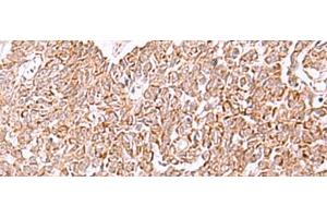 Immunohistochemistry of paraffin-embedded Human ovarian cancer tissue using IRX2 Polyclonal Antibody at dilution of 1:45(x200)