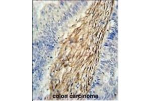 C3orf75 Antibody (C-term) (ABIN651356 and ABIN2840198) immunohistochemistry analysis in formalin fixed and paraffin embedded human colon carcinoma followed by peroxidase conjugation of the secondary antibody and DAB staining. (ELP6 抗体  (C-Term))