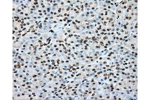 Immunohistochemical staining of paraffin-embedded Adenocarcinoma of colon tissue using anti-CYP1A2 mouse monoclonal antibody. (CYP1A2 抗体)