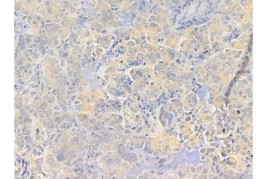 ABIN6257755 and ABIN6273649 at 1/100 staining human lung adenocarcinoma by IHC-P.