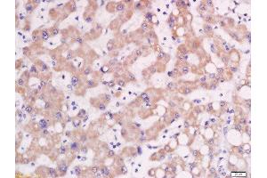 Formalin-fixed and paraffin embedded human lung carcinoma labeled with Rabbit Anti-AP1M2 Polyclonal Antibody, Unconjugated  at 1:200 followed by conjugation to the secondary antibody and DAB staining (AP1m2 抗体  (AA 1-100))