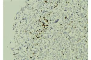 ABIN6272880 at 1/100 staining Human breast cancer tissue by IHC-P. (SGTA 抗体  (C-Term))
