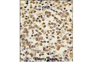 Formalin-fixed and paraffin-embedded human kideny carcinoma tissue reacted with ERK5 Antibody (C-term) (ABIN391722 and ABIN2841612) , which was peroxidase-conjugated to the secondary antibody, followed by DAB staining. (MAPK7 抗体  (C-Term))