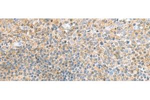 Immunohistochemistry of paraffin-embedded Human tonsil tissue using TSTA3 Polyclonal Antibody at dilution of 1:45(x200) (TSTA3 抗体)
