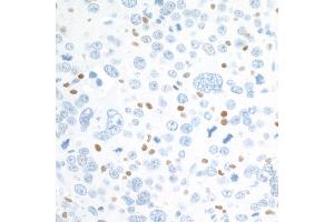 Immunohistochemistry (IHC) image for anti-V-Maf Musculoaponeurotic Fibrosarcoma Oncogene Homolog (Avian) (MAF) (AA 125-175) antibody (ABIN7455089) (Recombinant MAF 抗体  (AA 125-175))