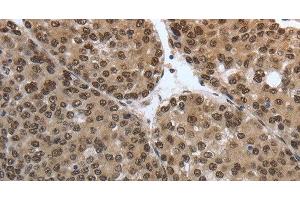 Immunohistochemistry of paraffin-embedded Human liver cancer tissue using SMAD7 Polyclonal Antibody at dilution 1:40 (SMAD7 抗体)