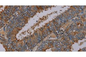 Immunohistochemistry of paraffin-embedded Human colon cancer tissue using PYY Polyclonal Antibody at dilution 1:30 (Peptide YY 抗体)
