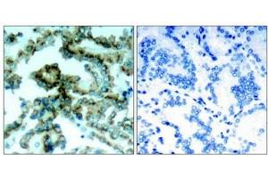 Immunohistochemical analysis of paraffin-embedded human lung carcinoma tissue, using PKCb(phospho-Thr641) antibody. (PKC beta 抗体  (pThr641))