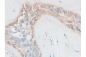 DAB staining on IHC-P; Samples: Human Breast cancer Tissue (FSTL1 抗体  (AA 21-308))