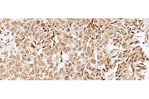 Immunohistochemistry of paraffin-embedded Human ovarian cancer tissue using ELAC1 Polyclonal Antibody at dilution of 1:50(x200) (ELAC1 抗体)