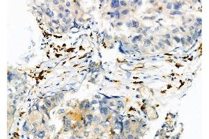 ABIN6264593 and ABIN6274042 at 1/100 staining Human pancreatic cancer by IHC-P.