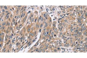 Immunohistochemistry of paraffin-embedded Human lung cancer using PPP1CC Polyclonal Antibody at dilution of 1:40 (PPP1CC 抗体)