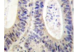 Immunohistochemistry analyzes of p47-phox antibody in paraffin-embedded human colon carcinoma tissue. (NCF1 抗体)
