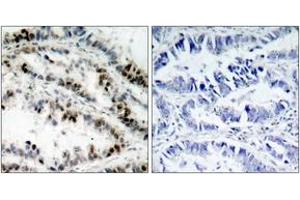 Immunohistochemistry analysis of paraffin-embedded human lung carcinoma, using SMC1 (Phospho-Ser957) Antibody. (SMC1A 抗体  (pSer957))