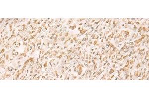 Immunohistochemistry of paraffin-embedded Human gastric cancer tissue using SETD1A Polyclonal Antibody at dilution of 1:25(x200) (SETD1A 抗体)