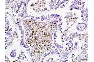 Formalin-fixed and paraffin embedded human lung carcinoma labeled with Anti-DKK3 Polyclonal Antibody, Unconjugated (ABIN749123) followed by conjugation to the secondary antibody and DAB staining (DKK3 抗体  (AA 31-130))
