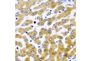 Immunohistochemical analysis of MDH2 staining in human liver cancer formalin fixed paraffin embedded tissue section.