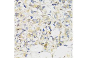 Immunohistochemistry of paraffin-embedded human breast cancer using MLKL antibody (ABIN6134395, ABIN6143882, ABIN6143886 and ABIN6217454) at dilution of 1:100 (40x lens). (MLKL 抗体  (C-Term))