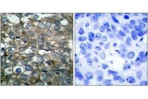 Immunohistochemistry analysis of paraffin-embedded human breast carcinoma tissue, using EGFR (Ab-869) Antibody.