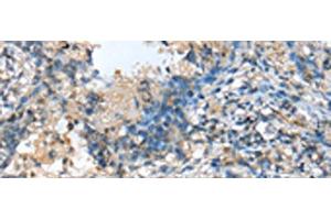 Immunohistochemistry of paraffin-embedded Human lung cancer tissue using MOB4 Polyclonal Antibody at dilution of 1:25(x200) (MOBKL3 抗体)