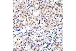 Immunohistochemistry of paraffin-embedded human breast carcinoma tissue, using Phospho-CDKN1B-T187 antibody (ABIN2987947). (CDKN1B 抗体  (pThr187))