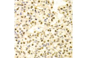 Immunohistochemistry of paraffin-embedded human kidney cancer using HDGF Antibody (ABIN1876535) at dilution of 1:100 (40x lens). (HDGF 抗体)