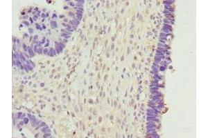 Immunohistochemistry of paraffin-embedded human ovarian cancer using ABIN7145624 at dilution of 1:100 (BPGM 抗体  (AA 1-259))