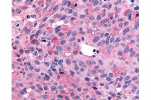 Anti-WNK1 / p65 antibody IHC of human Skin, Melanoma. (WNK1 抗体  (C-Term))