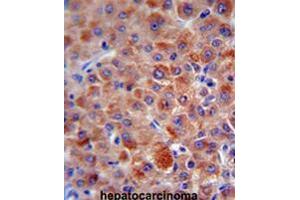CFH antibody (Center) immunohistochemistry analysis in formalin fixed and paraffin embedded human hepatocarcinoma followed by peroxidase conjugation of the secondary antibody and DAB staining.