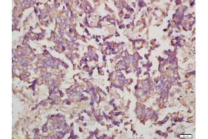 Formalin-fixed and paraffin embedded human lung carcinoma labeled with Rabbit Anti-Myosin VIIa Polyclonal Antibody, Unconjugated  at 1:200 followed by conjugation to the secondary antibody and DAB staining (Myosin VIIA 抗体  (AA 851-950))