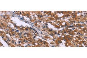 Immunohistochemistry of paraffin-embedded Human thyroid cancer tissue using SKI Polyclonal Antibody at dilution 1:40 (SKI 抗体)