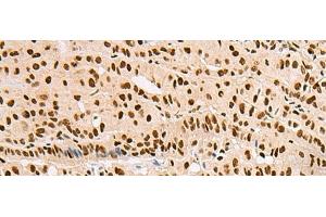 Immunohistochemistry of paraffin-embedded Human thyroid cancer tissue using XRCC4 Polyclonal Antibody at dilution of 1:60(x200) (XRCC4 抗体)