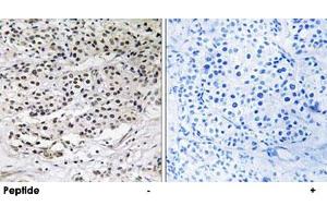 Immunohistochemistry analysis of paraffin-embedded human breast carcinoma tissue using AZI1 polyclonal antibody . (AZI1 抗体)