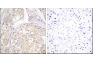 Immunohistochemistry analysis of paraffin-embedded human breast carcinoma, using FGFR1 (Phospho-Tyr766) Antibody. (FGFR1 抗体  (pTyr766))