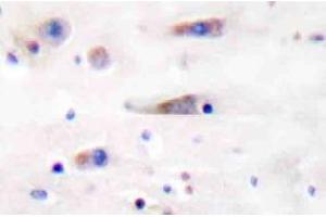 Immunohistochemistry (IHC) analyzes of NMDAzeta1 antibody in paraffin-embedded human breast carcinoma tissue. (NMDA 1 Receptor 抗体)