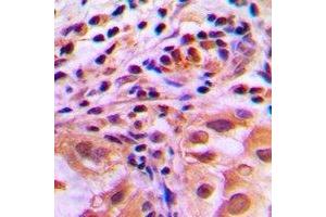 Immunohistochemical analysis of FOXO1 (pS256) staining in human lung cancer formalin fixed paraffin embedded tissue section. (FOXO1 抗体  (pSer256))