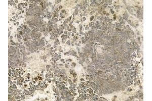 ABIN6261003 and ABIN6273036 at 1/100 staining human melanoma by IHC-P. (Complexin 1 抗体  (N-Term))