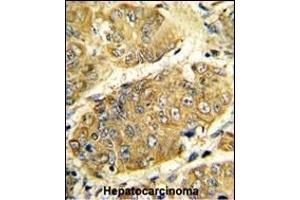 Formalin-fixed and paraffin-embedded human hepatocarcinoma reacted with LTA Antibody (Center), which was peroxidase-conjugated to the secondary antibody, followed by DAB staining. (LTA 抗体  (AA 46-72))