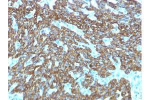 Formalin-fixed, paraffin-embedded human Skin stained with Cytokeratin, HMW Rabbit Recombinant Monoclonal Antibody (KRTH/1576R). (Recombinant Cytokeratin 2 抗体)