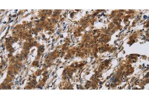 Immunohistochemistry of paraffin-embedded Human gastic cancer using IL17RB Polyclonal Antibody at dilution of 1:40 (IL17 Receptor B 抗体)