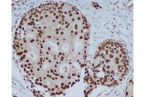 Immunohistochemical analysis of paraffin-embedded human breast carcinoma with HP1 alpha mouse mAb (3G2-H10-A6, 1:400 diluted ),showing nuclear localization. (CBX5 抗体)