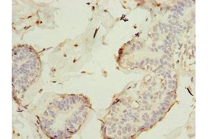 Immunohistochemistry of paraffin-embedded human breast cancer using ABIN7157312 at dilution of 1:100 (KEL 抗体  (AA 201-500))