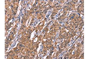 The image on the left is immunohistochemistry of paraffin-embedded Human gastic cancer tissue using ABIN7190999(HRASLS2 Antibody) at dilution 1/20, on the right is treated with synthetic peptide. (HRASLS2 抗体)