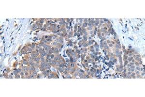 Immunohistochemistry of paraffin-embedded Human thyroid cancer tissue using UBQLN2 Polyclonal Antibody at dilution of 1:45(x200) (Ubiquilin 2 抗体)