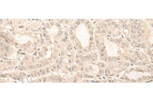 Immunohistochemistry of paraffin-embedded Human thyroid cancer tissue using UBXN1 Polyclonal Antibody at dilution of 1:35(x200) (UBXN1 抗体)